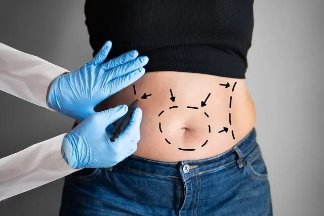tummy-tuck-surgery